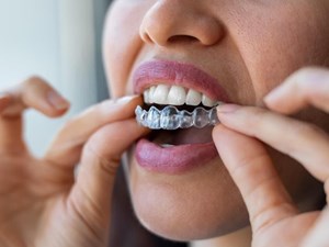 ¿En qué casos se puede optar por la ortodoncia invisible?