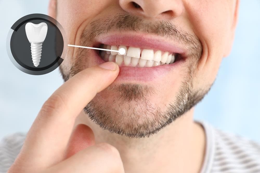 Todo sobre implantes dentales