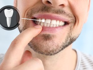 Todo sobre implantes dentales