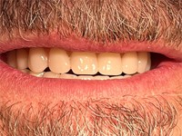 3 ventajas de los implantes dentales de carga inmediata