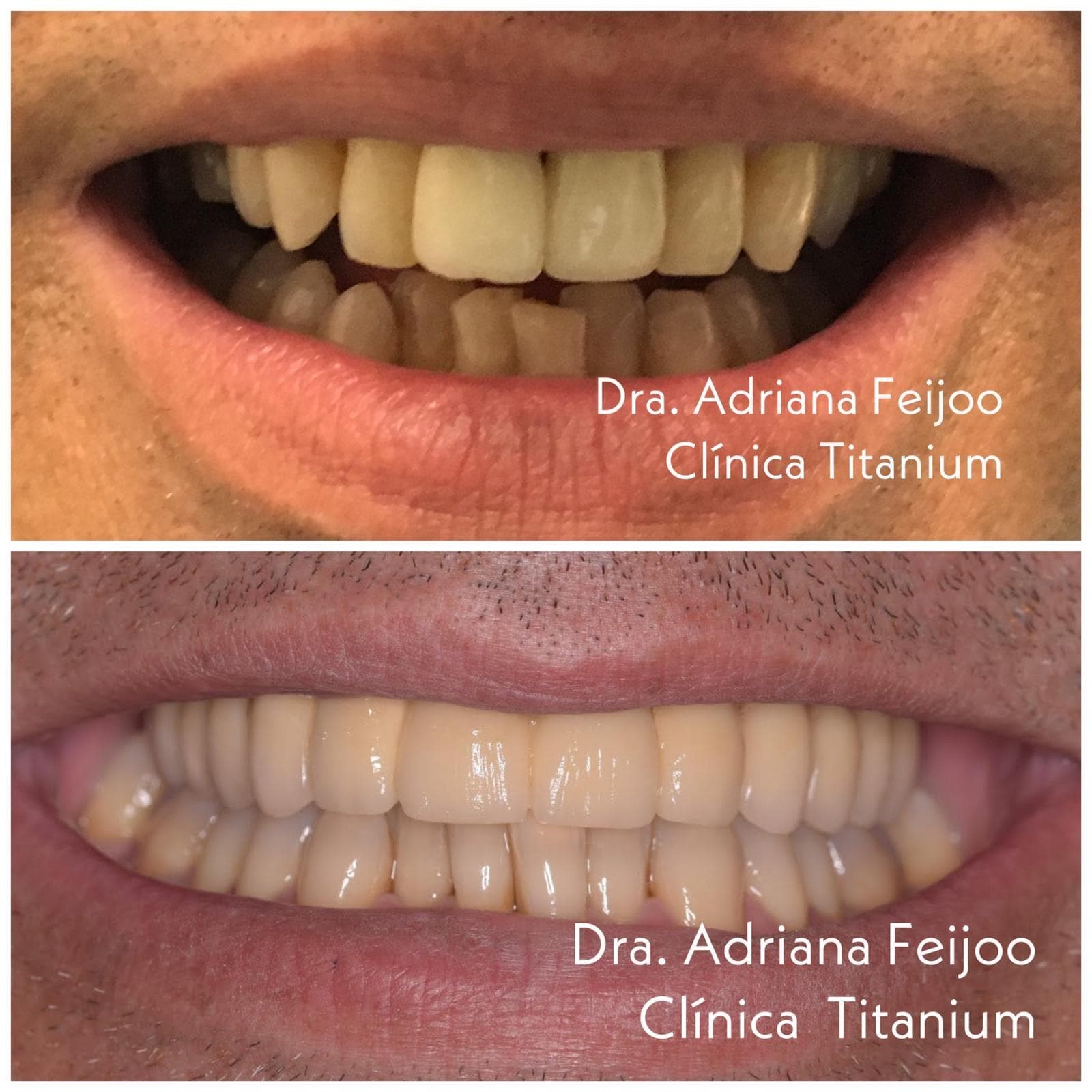 40% de descuento en implantes dentales en Vigo - Imagen 1