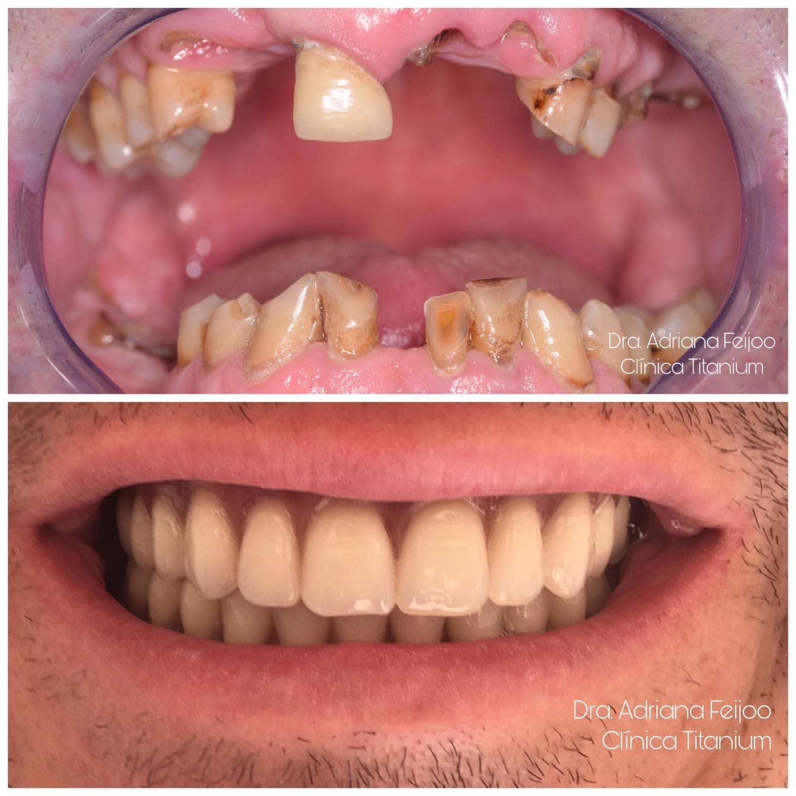 40% de descuento en implantes dentales en Vigo - Imagen 2