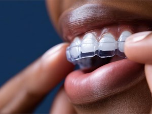 5 beneficios de la ortodoncia invisible más allá de la estética