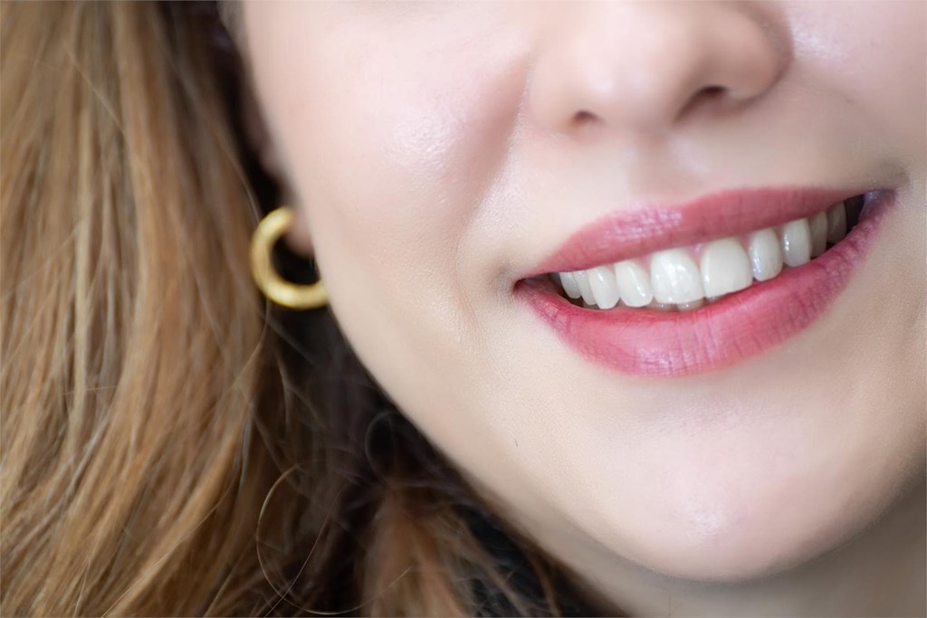 5 ventajas de las carillas dentales para mejorar tu estética dental