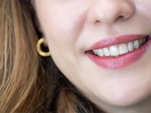 5 ventajas de las carillas dentales para mejorar tu estética dental