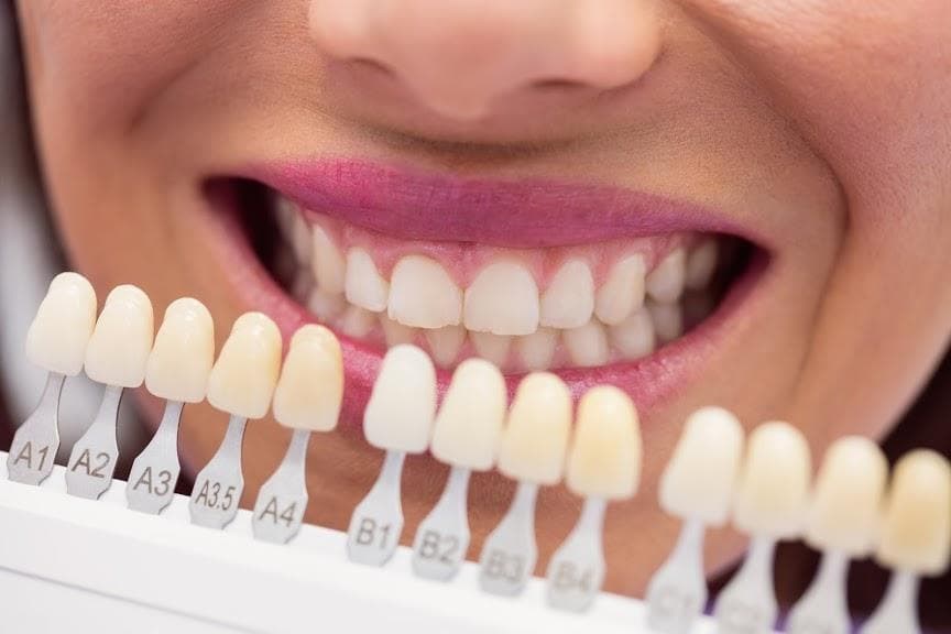 Carillas dentales sin desgastar las piezas naturales - Imagen 1
