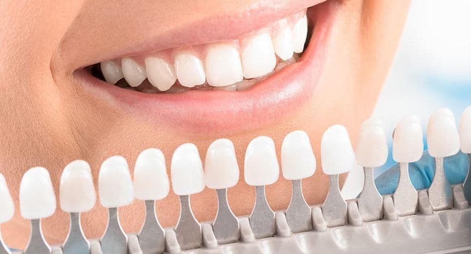 ¿Cómo cuidar carillas dentales?