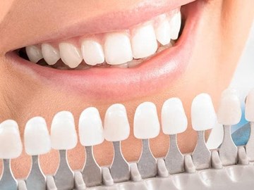 ¿Cómo cuidar carillas dentales?