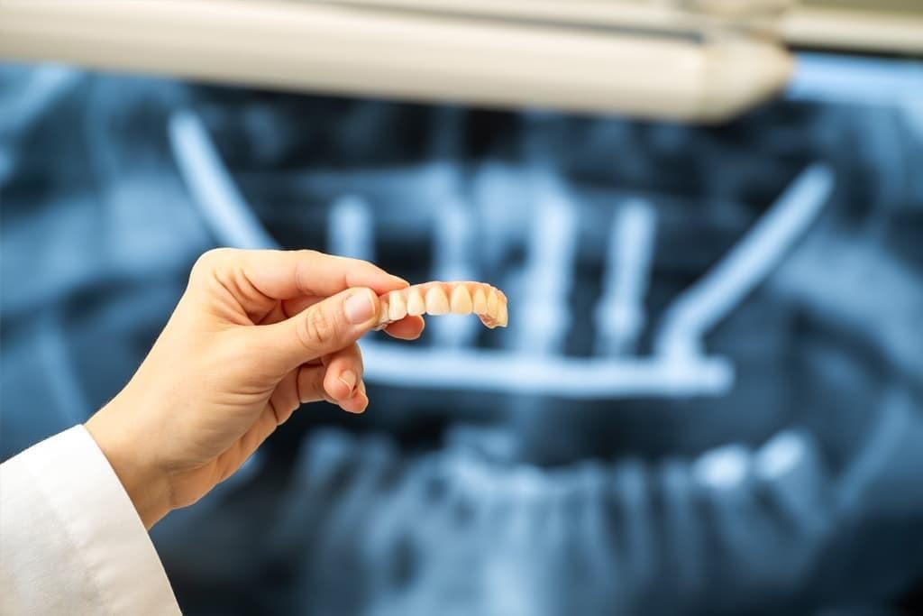 ¿Cómo es el procedimiento de un implante zigomático sin injerto?