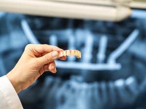 ¿Cómo es el procedimiento de un implante zigomático sin injerto?