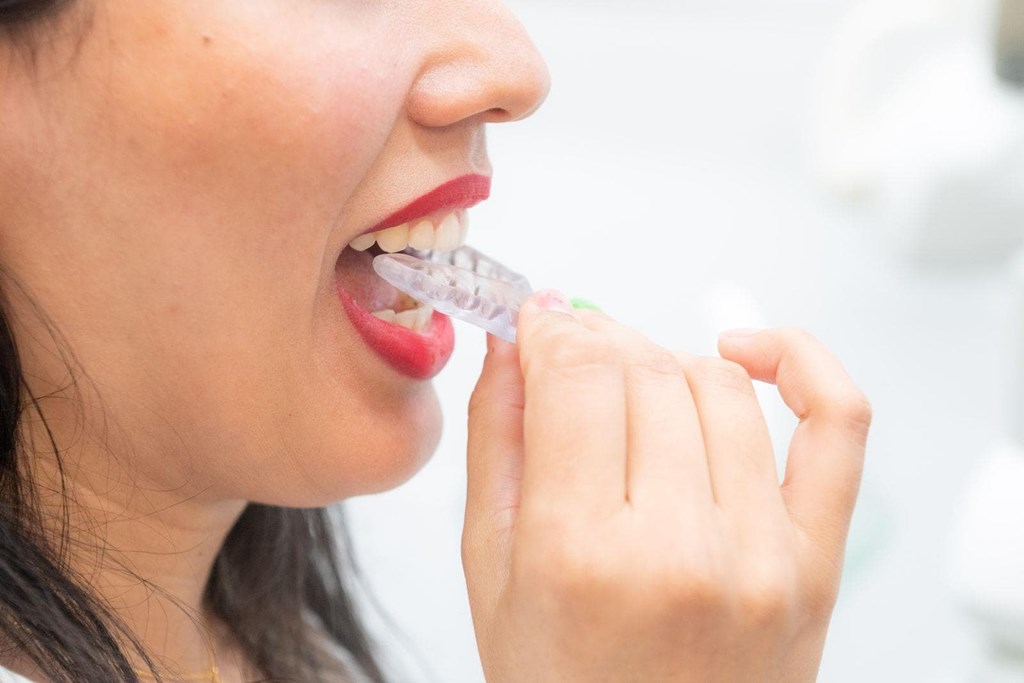 ¿Cómo saber si la ortodoncia Invisalign es el tratamiento que necesito?
