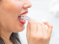 ¿Cómo saber si la ortodoncia Invisalign es el tratamiento que necesito?