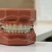 Cómo saber si necesitas brackets