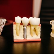 ¿Cuándo es necesario colocar implantes dentales?