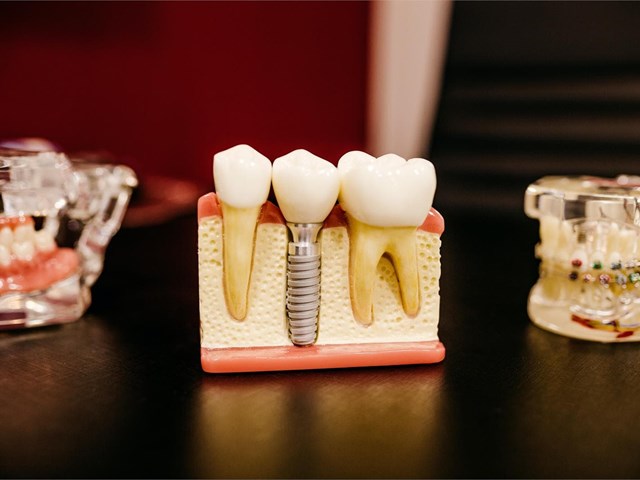 ¿Cuándo es necesario colocar implantes dentales?