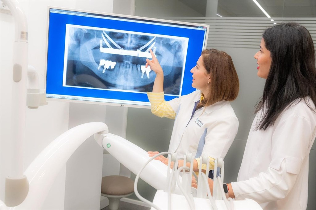 ¿Cuándo es recomendable optar por implantes cigomáticos?