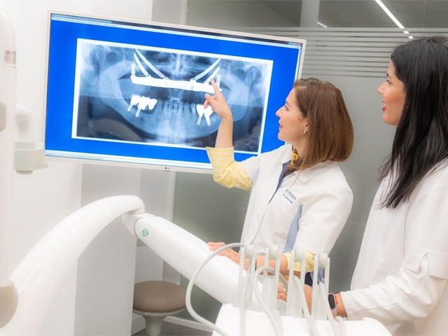 ¿Cuándo es recomendable optar por implantes cigomáticos?