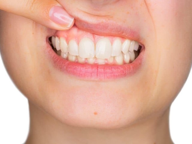 ¿Cuándo saber que se necesita una periodoncia?