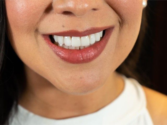 ¿Cuánto duran las carillas dentales y cómo cuidarlas?