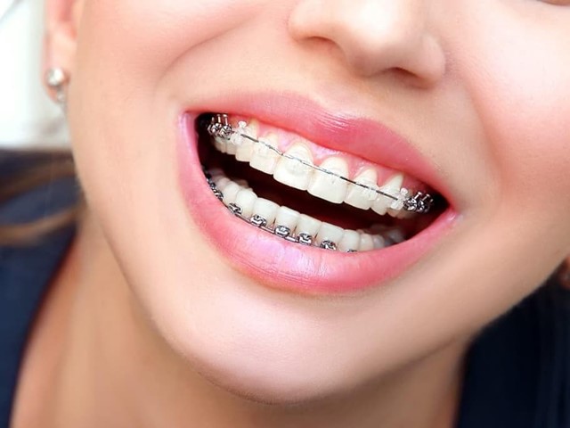 ¿Cuánto duran los brackets de zafiro?