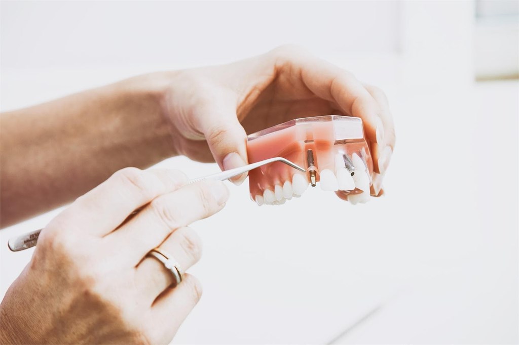 ¿Cuanto tarda el proceso de un implante dental?
