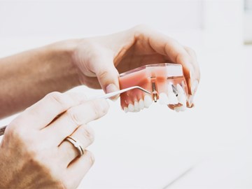 ¿Cuanto tarda el proceso de un implante dental?