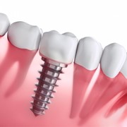 Descubre los beneficios del Sistema All on 4