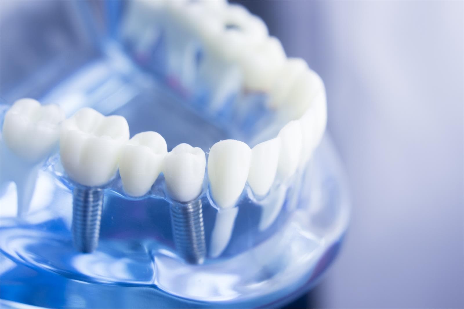 Descubre nuestro innovador tratamiento de implantología dental en Vigo - Imagen 1