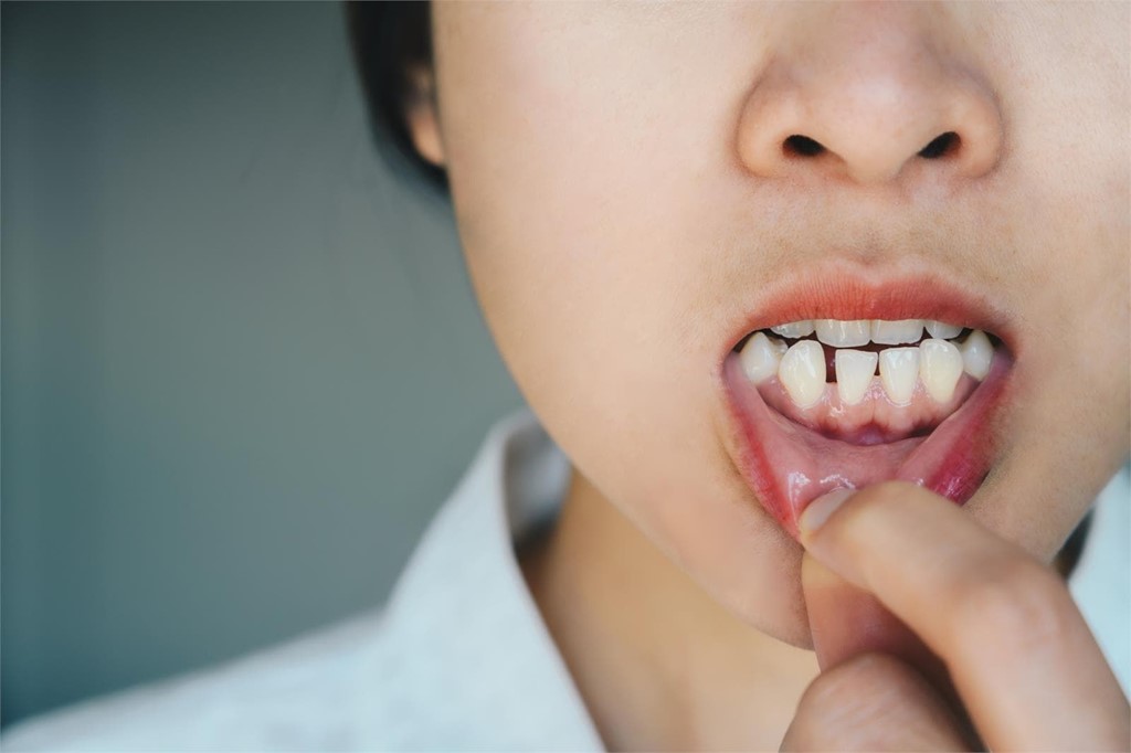 ¿Dientes desalineados? consigue la sonrisa perfecta