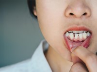 ¿Dientes desalineados? consigue la sonrisa perfecta