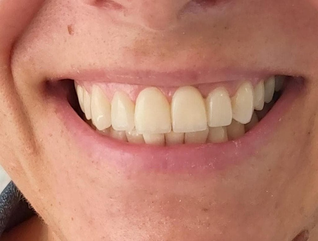 ¡En el 2023 luce tu mejor sonrisa gracias a las carillas dentales!
