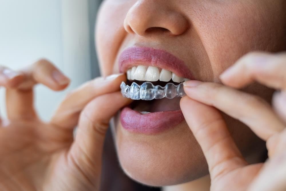 ¿En qué casos se puede optar por la ortodoncia invisible?