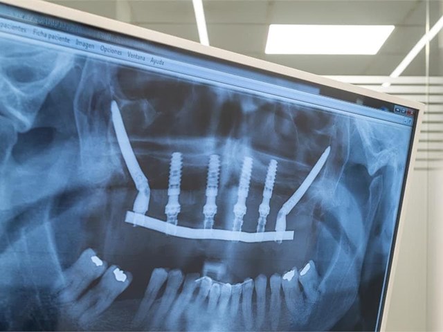 ¿Es doloroso el proceso de colocación de implantes dentales?