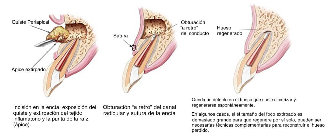 Apicectomías