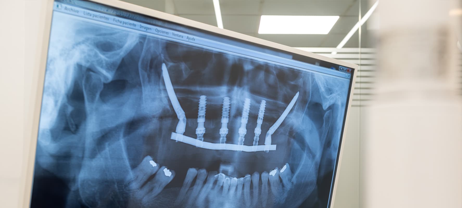 Implantes zigomáticos, la alternativa perfecta a los injertos