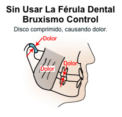 Efectos del bruxismo