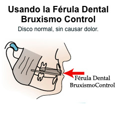 Efectos del bruxismo