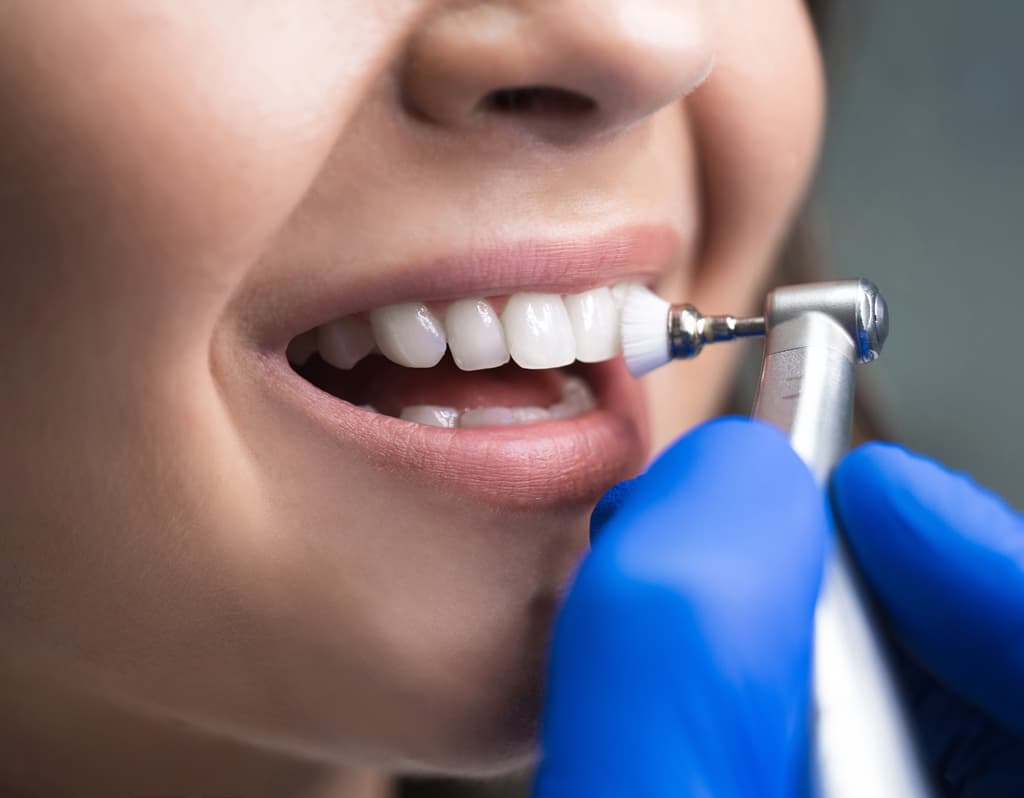 ¿Cómo cuidar las carillas dentales?