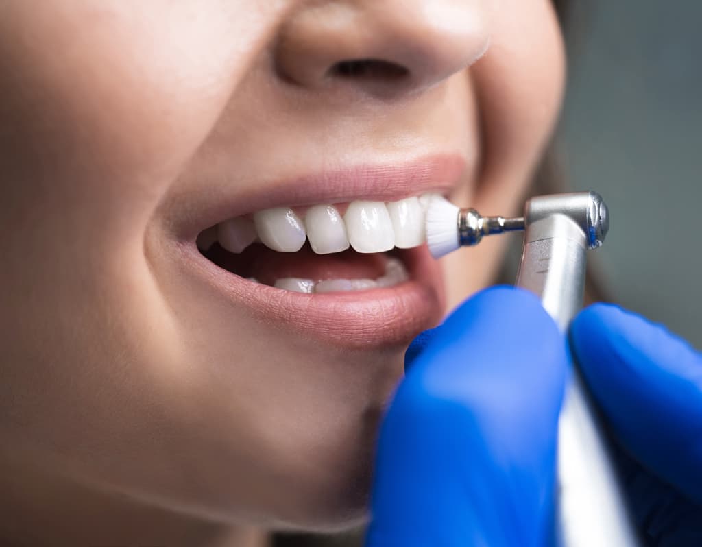 ¿Cuánto cuestan las carillas dentales en nuestra clínica dental en Vigo?