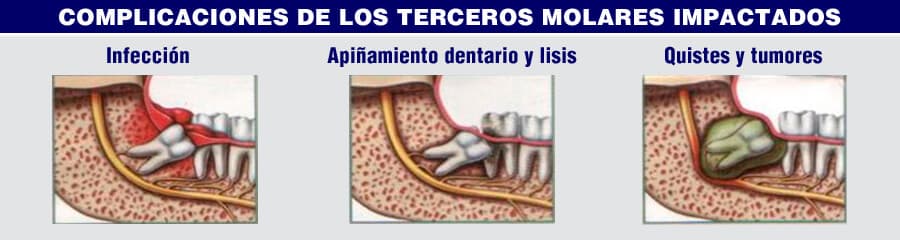 Dientes retenidos - Tratamiento