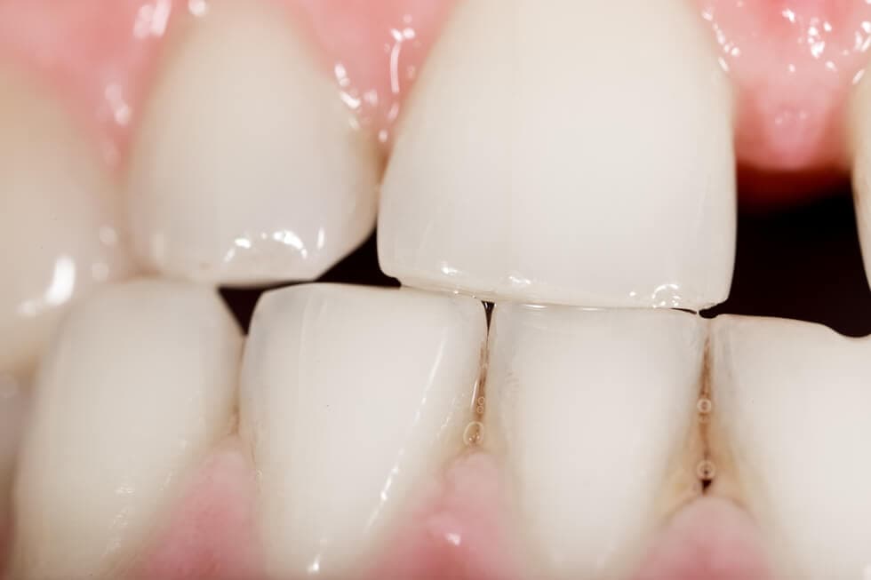 ¿Dientes definitivos que no salen? Te contamos por qué
