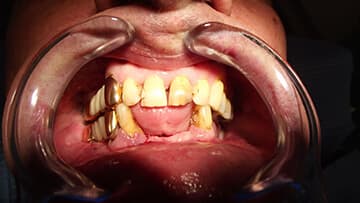 ¿Qué es la enfermedad periodontal?