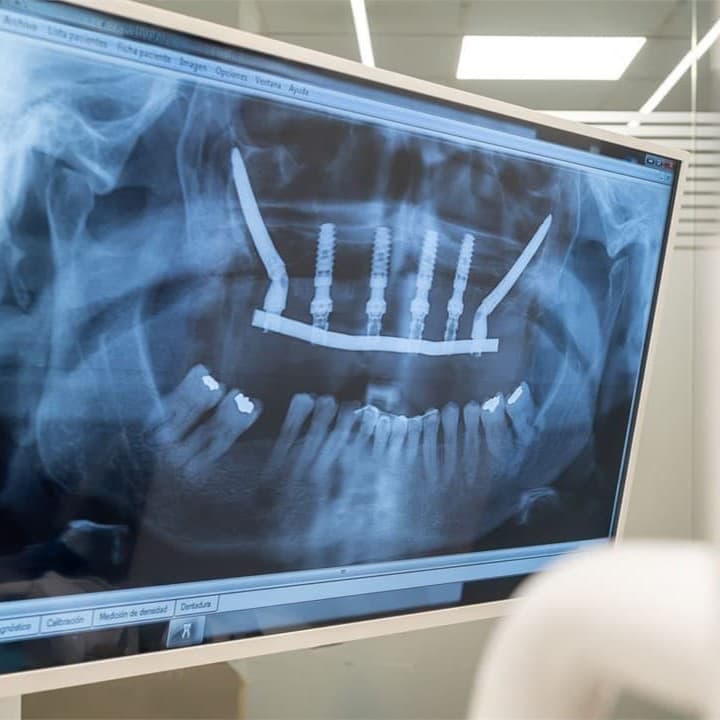 Especialistas en implantes dentales en Vigo