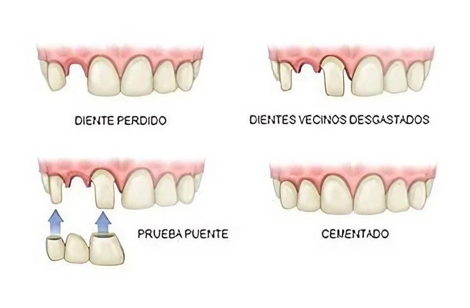 Prótesis Fijas