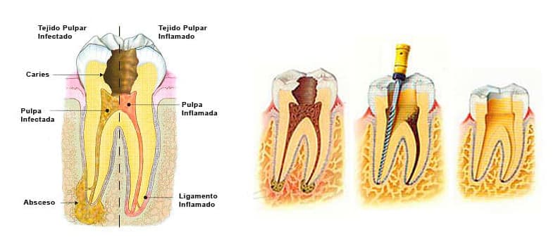 Endodoncia en Vigo