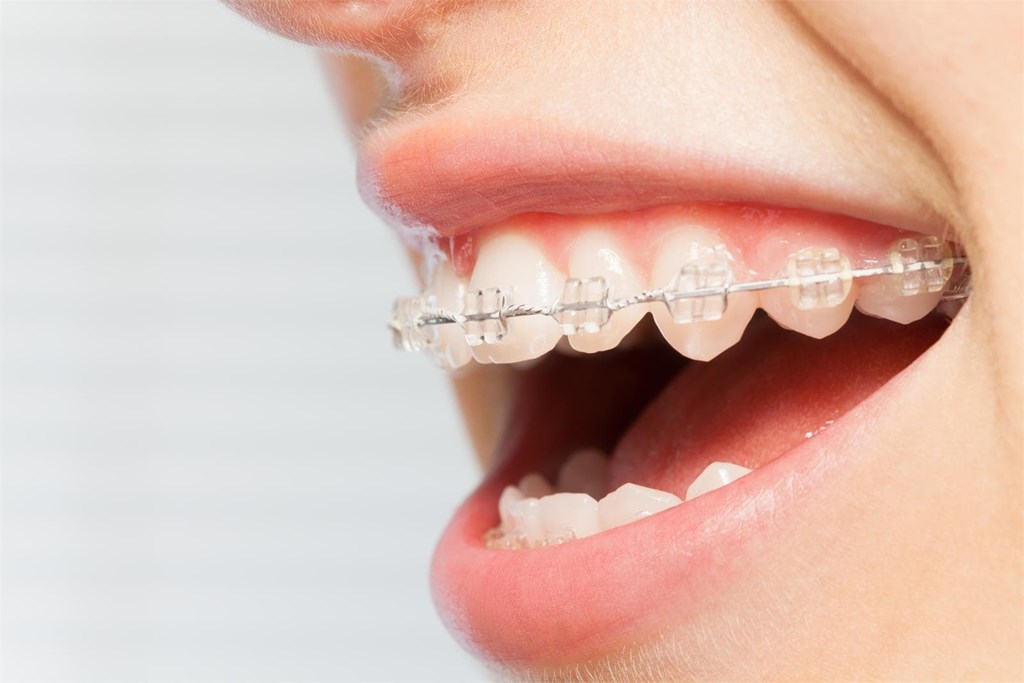Limpieza y mantenimiento de pacientes con ortodoncia