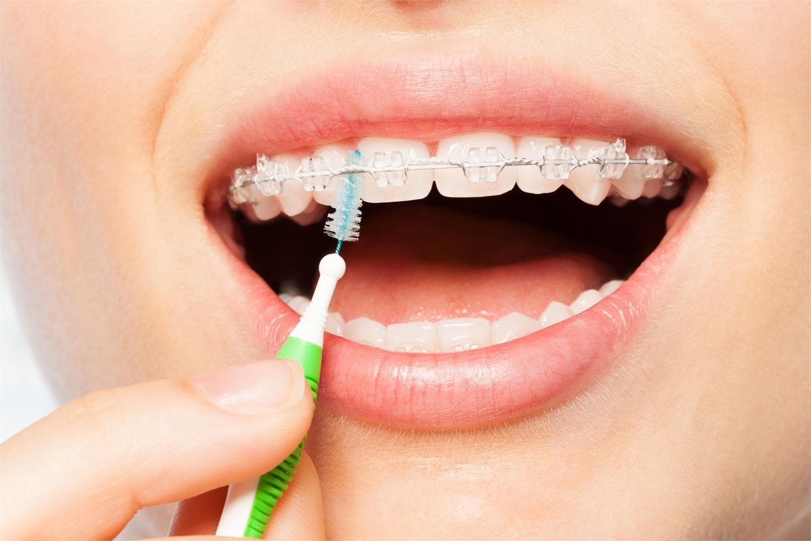 Limpieza y mantenimiento de pacientes con ortodoncia - Imagen 1