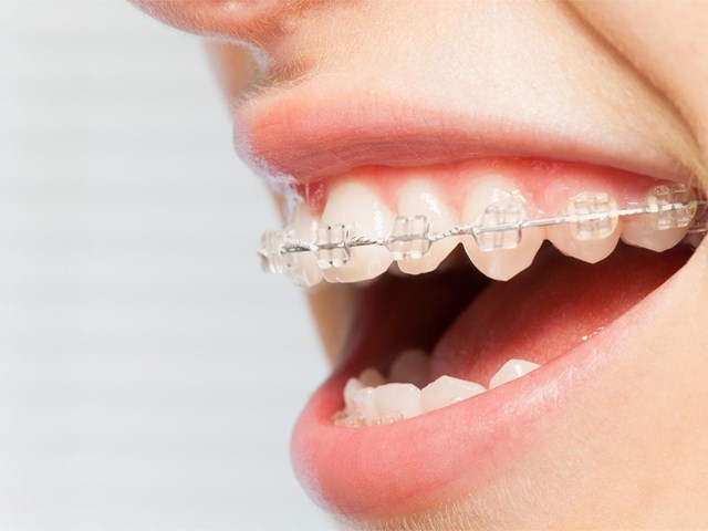Limpieza y mantenimiento de pacientes con ortodoncia