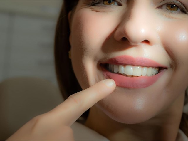 Mitos comunes sobre las carillas dentales