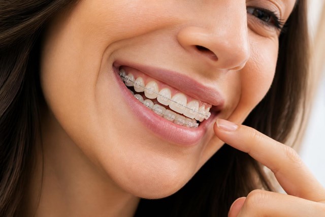 Ortodoncia estética con brackets de zafiro en Vigo - Imagen 1